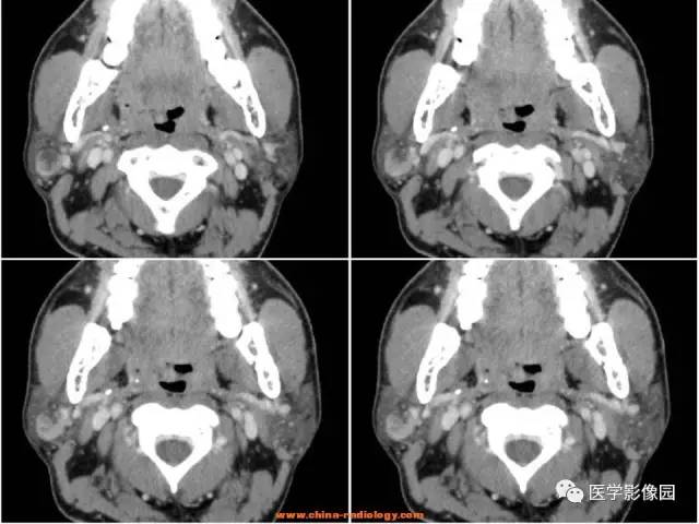 【病例】腮腺基底细胞腺瘤1例CT影像表现 【病例】腮腺基底细胞腺瘤1例CT影像表现