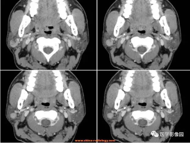 【病例】腮腺基底细胞腺瘤1例CT影像表现 【病例】腮腺基底细胞腺瘤1例CT影像表现