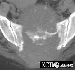 【病例】骶尾部脊索瘤1例X线CT影像表现
