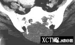 【病例】骶尾部脊索瘤1例X线CT影像表现 【病例】骶尾部脊索瘤1例X线CT影像表现