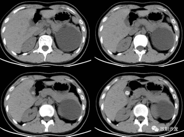 【病例】胰腺粘液性囊腺瘤1例CT影像诊断与鉴别