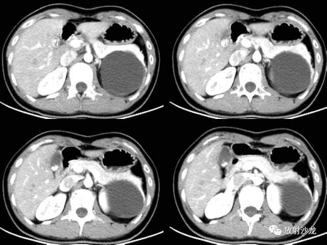 【病例】胰腺粘液性囊腺瘤1例CT影像诊断与鉴别 【病例】胰腺粘液性囊腺瘤1例CT影像诊断与鉴别