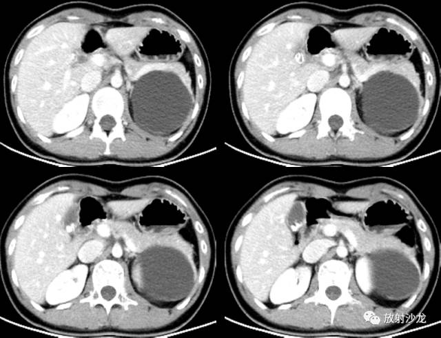 【病例】胰腺粘液性囊腺瘤1例CT影像诊断与鉴别 【病例】胰腺粘液性囊腺瘤1例CT影像诊断与鉴别