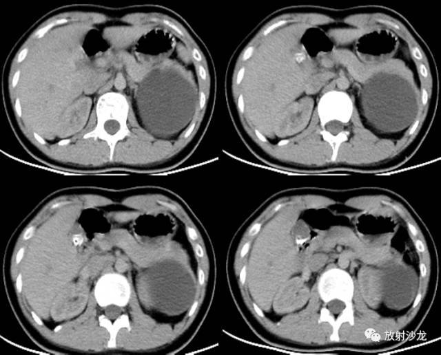 【病例】胰腺粘液性囊腺瘤1例CT影像诊断与鉴别 【病例】胰腺粘液性囊腺瘤1例CT影像诊断与鉴别