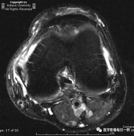 【病例】内侧副韧带部分撕裂1例MR影像表现 【病例】内侧副韧带部分撕裂1例MR影像表现