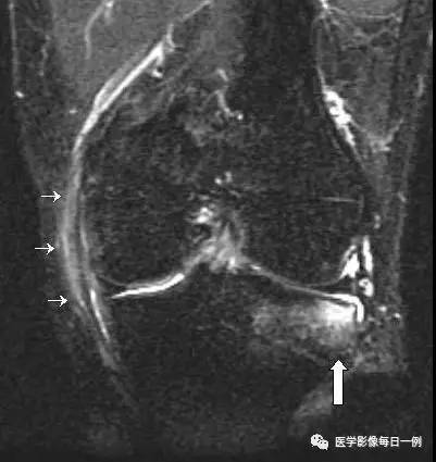 【病例】内侧副韧带部分撕裂1例MR影像表现 【病例】内侧副韧带部分撕裂1例MR影像表现