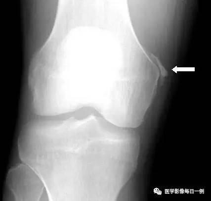 【病例】内侧副韧带部分撕裂1例MR影像表现 【病例】内侧副韧带部分撕裂1例MR影像表现