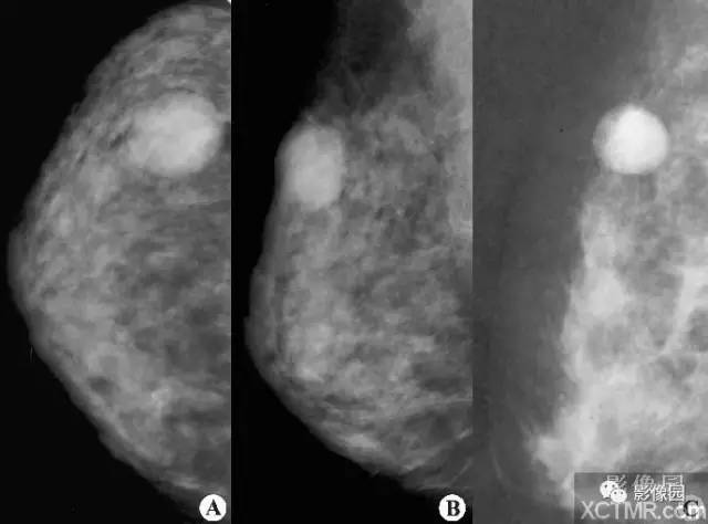 【病例】乳腺纤维腺瘤1例X线钼靶影像表现