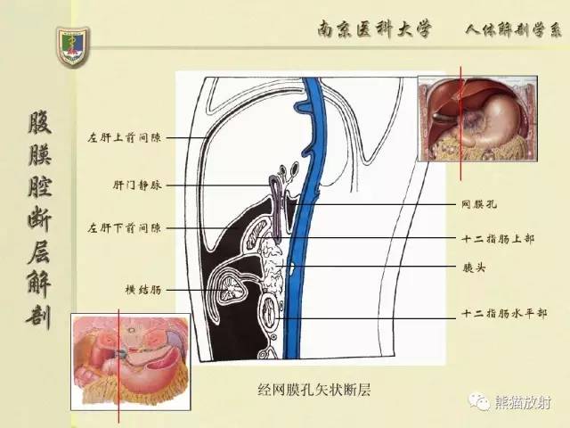 【解剖】腹膜及腹膜腔(经典讲解汇总) 【解剖】腹膜及腹膜腔(经典讲解汇总)