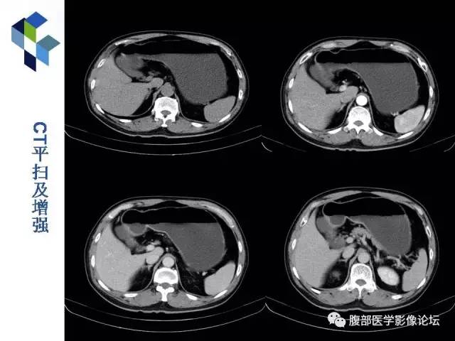 【病例】胃小弯异位胰腺1例CT影像表现 【病例】胃小弯异位胰腺1例CT影像表现