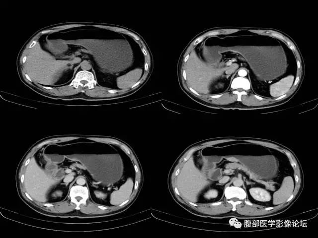 【病例】胃小弯异位胰腺1例CT影像表现