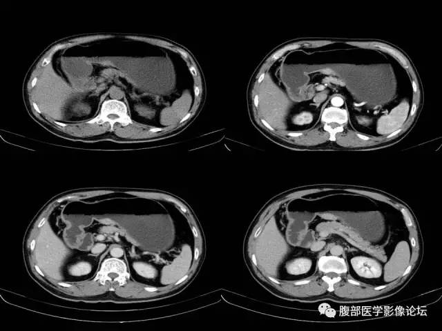 【病例】胃小弯异位胰腺1例CT影像表现 【病例】胃小弯异位胰腺1例CT影像表现