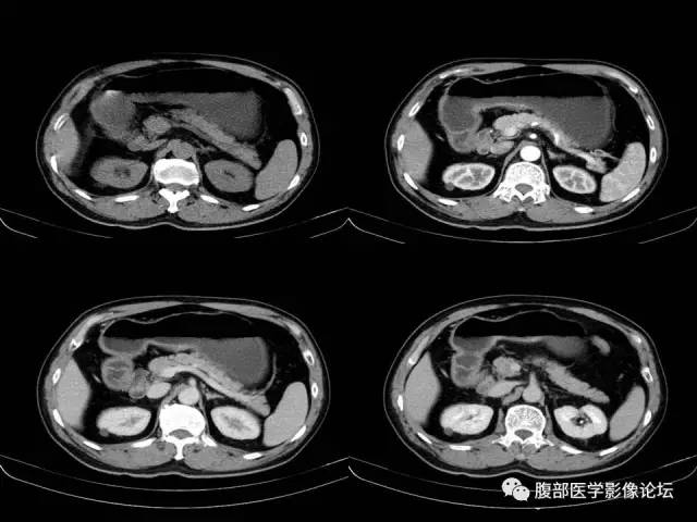 【病例】胃小弯异位胰腺1例CT影像表现 【病例】胃小弯异位胰腺1例CT影像表现