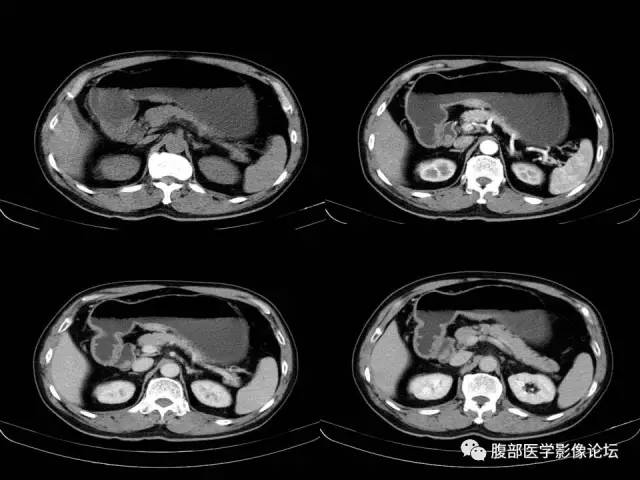 【病例】胃小弯异位胰腺1例CT影像表现 【病例】胃小弯异位胰腺1例CT影像表现