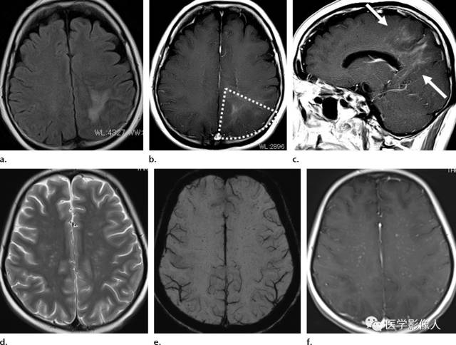 10种大脑髓静脉相关疾病影像学表现 10种大脑髓静脉相关疾病影像学表现