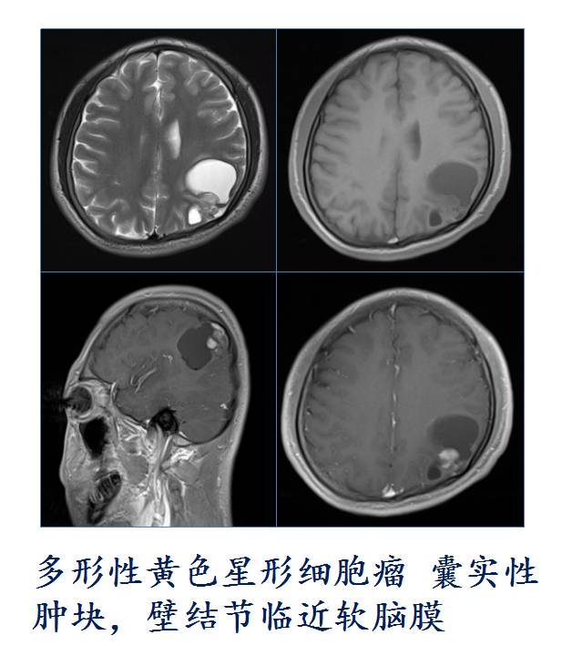 【PPT】大脑实质内大囊小结节肿瘤、 钙化肿瘤