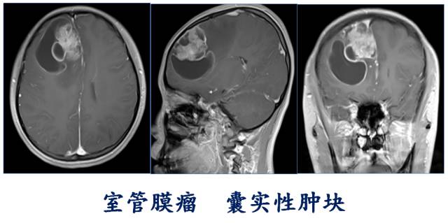 【PPT】大脑实质内大囊小结节肿瘤、 钙化肿瘤