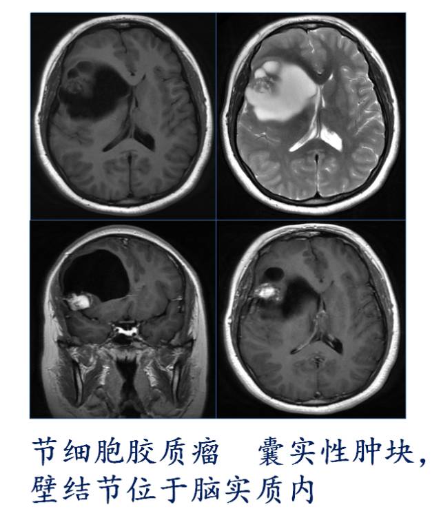 【PPT】大脑实质内大囊小结节肿瘤、 钙化肿瘤