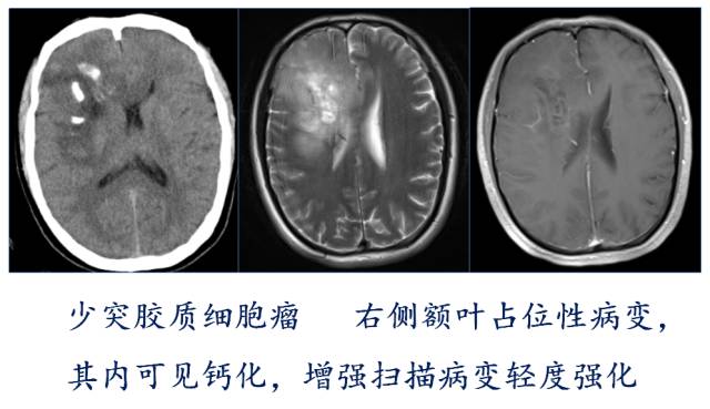 【PPT】大脑实质内大囊小结节肿瘤、 钙化肿瘤