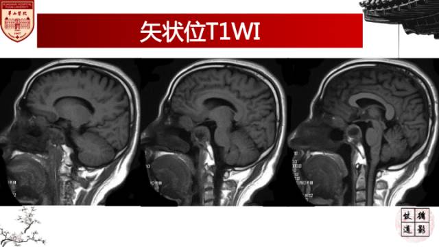 【病例】鼻腔鼻窦曲霉菌病累及颅内1例MR诊断分析