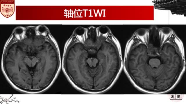 【病例】鼻腔鼻窦曲霉菌病累及颅内1例MR诊断分析