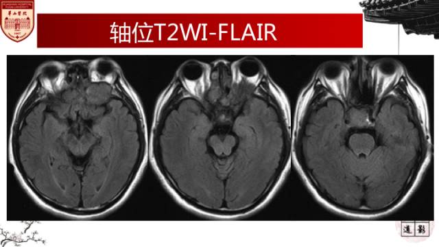 【病例】鼻腔鼻窦曲霉菌病累及颅内1例MR诊断分析