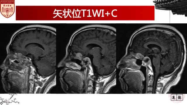 【病例】鼻腔鼻窦曲霉菌病累及颅内1例MR诊断分析