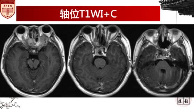 【病例】鼻腔鼻窦曲霉菌病累及颅内1例MR诊断分析