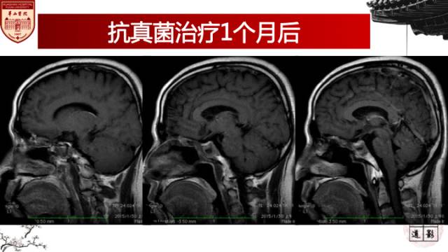 【病例】鼻腔鼻窦曲霉菌病累及颅内1例MR诊断分析