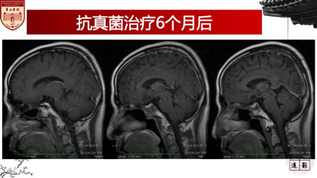 【病例】鼻腔鼻窦曲霉菌病累及颅内1例MR诊断分析