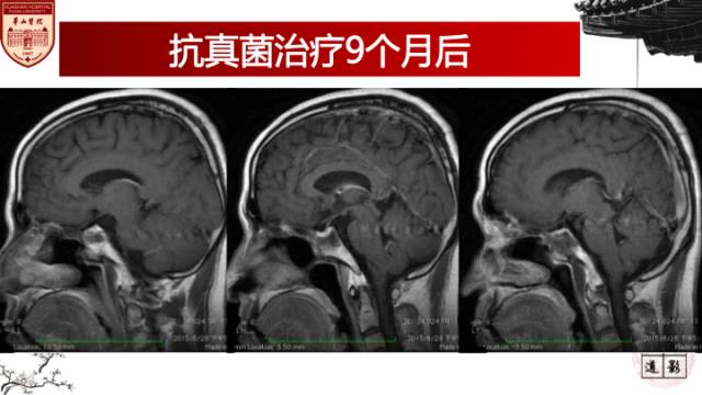 【病例】鼻腔鼻窦曲霉菌病累及颅内1例MR诊断分析