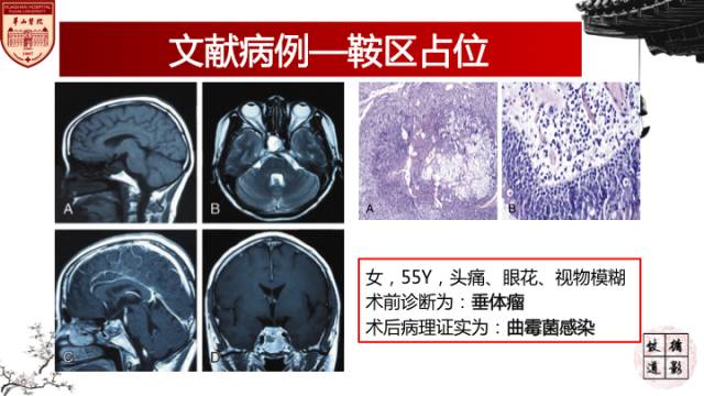 【病例】鼻腔鼻窦曲霉菌病累及颅内1例MR诊断分析