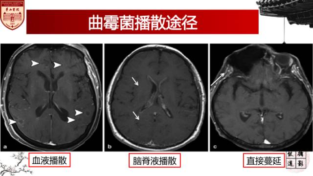 【病例】鼻腔鼻窦曲霉菌病累及颅内1例MR诊断分析