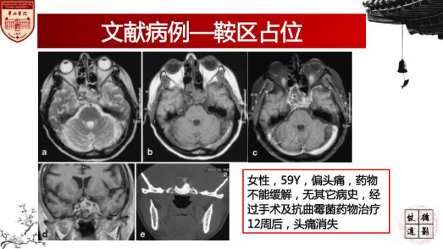 【病例】鼻腔鼻窦曲霉菌病累及颅内1例MR诊断分析