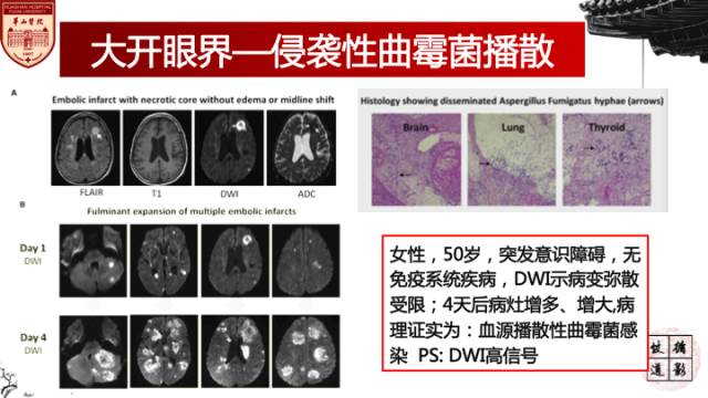 【病例】鼻腔鼻窦曲霉菌病累及颅内1例MR诊断分析