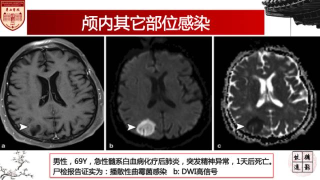 【病例】鼻腔鼻窦曲霉菌病累及颅内1例MR诊断分析