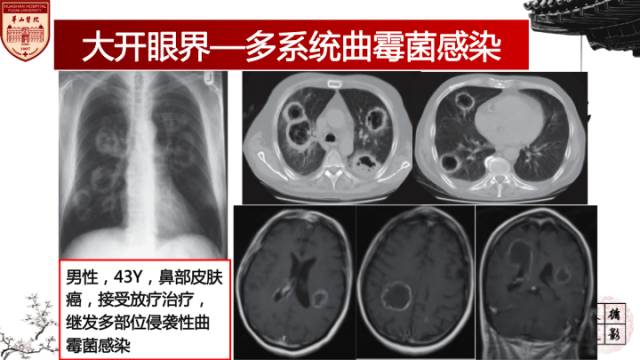【病例】鼻腔鼻窦曲霉菌病累及颅内1例MR诊断分析