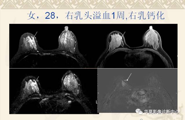 【PPT】乳腺导管原位癌的MRI诊断
