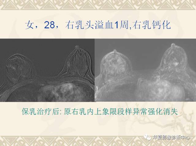 【PPT】乳腺导管原位癌的MRI诊断