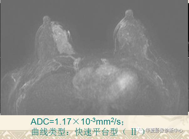 【PPT】乳腺导管原位癌的MRI诊断