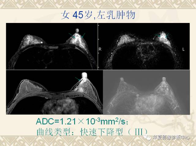 【PPT】乳腺导管原位癌的MRI诊断