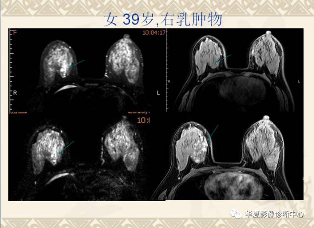 【PPT】乳腺导管原位癌的MRI诊断