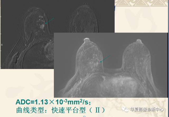 【PPT】乳腺导管原位癌的MRI诊断