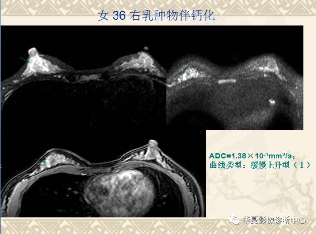【PPT】乳腺导管原位癌的MRI诊断