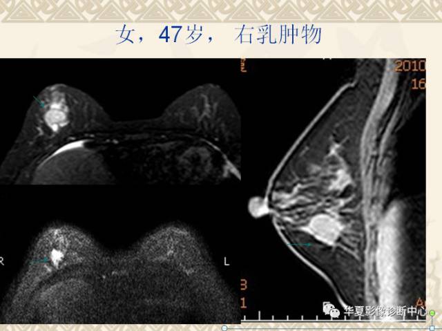 【PPT】乳腺导管原位癌的MRI诊断