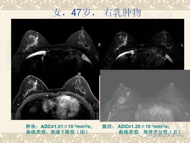【PPT】乳腺导管原位癌的MRI诊断