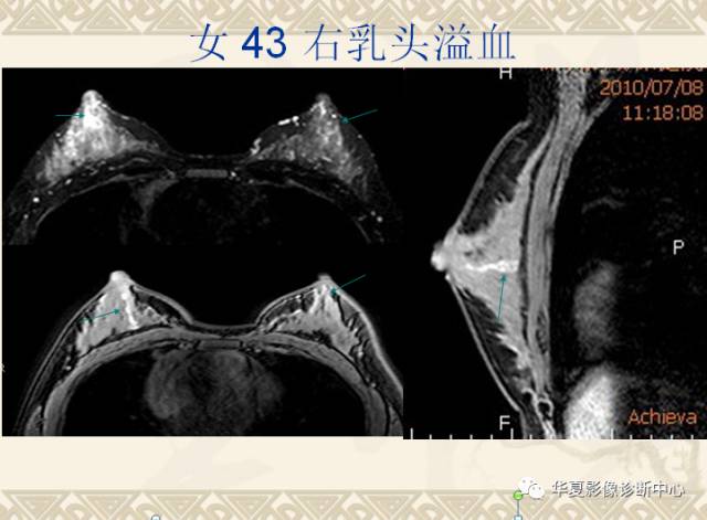 【PPT】乳腺导管原位癌的MRI诊断