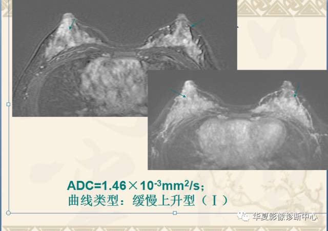 【PPT】乳腺导管原位癌的MRI诊断