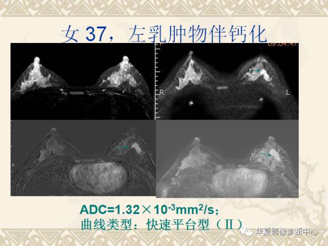 【PPT】乳腺导管原位癌的MRI诊断