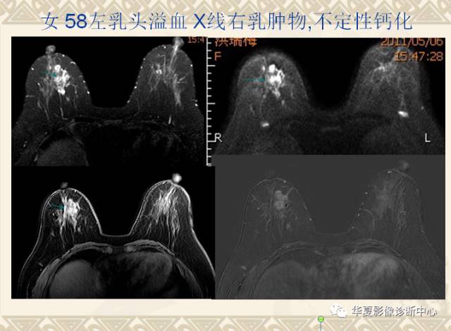【PPT】乳腺导管原位癌的MRI诊断